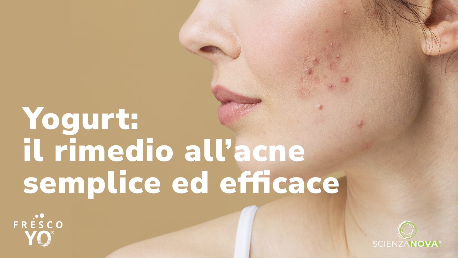 Yogurt e acne: Un rimedio semplice ed efficace